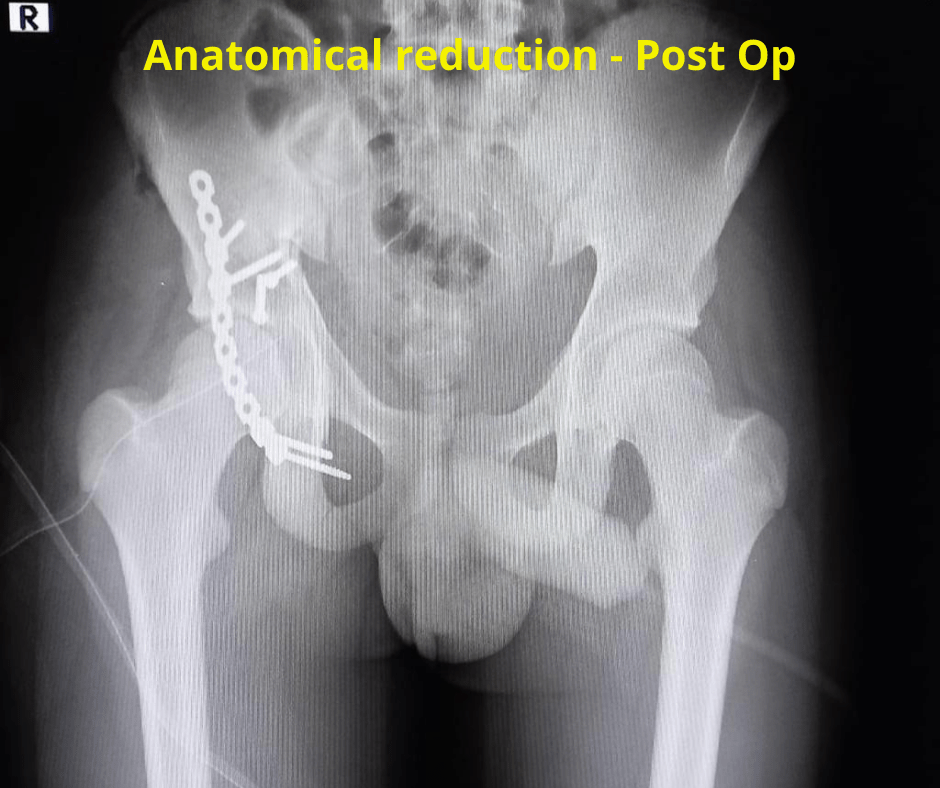 Anatomical reduction - Post Op