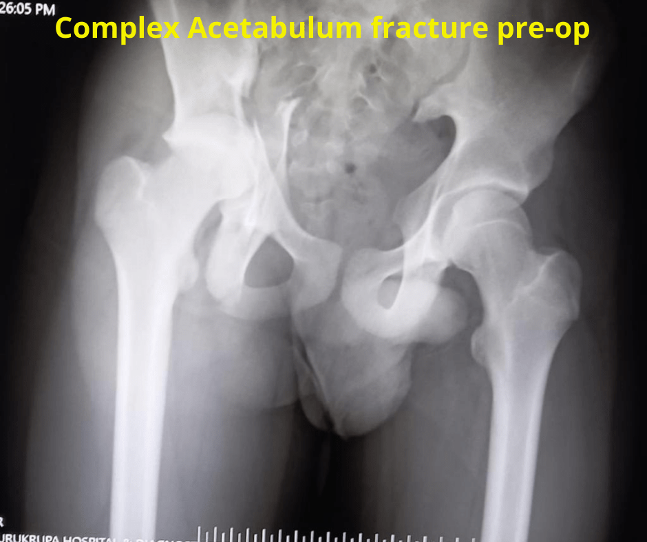 Complex Acetabulum fracture pre-op