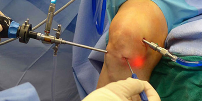 knee-arthroscopy